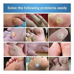 Lion Ball Corn Removal Plaster Cap Callus Warts 6's x 3 Pack