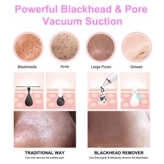 Gdeal LCD Blackhead Remover Facial Skin Pore Cleaner